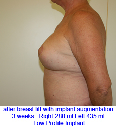 plastic-surgery-breast-lift-augmentation